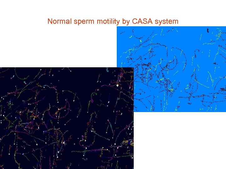 Normal sperm motility by CASA system 