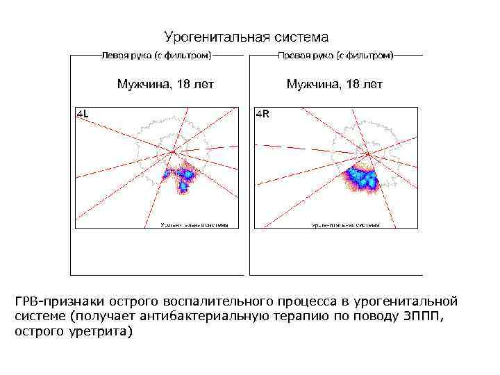 Мужчина, 18 лет ГРВ-признаки острого воспалительного процесса в урогенитальной системе (получает антибактериальную терапию по