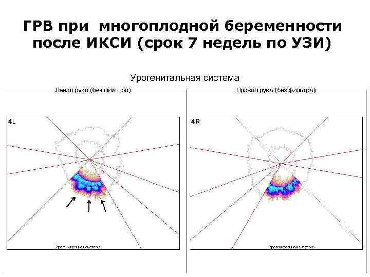 ГРВ при многоплодной беременности после ИКСИ (срок 7 недель по УЗИ) 