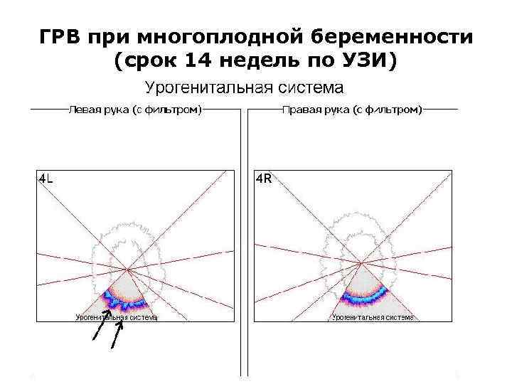 ГРВ при многоплодной беременности (срок 14 недель по УЗИ) 