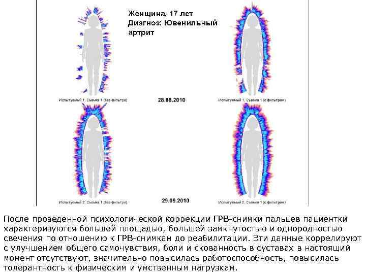 После проведенной психологической коррекции ГРВ-снимки пальцев пациентки характеризуются большей площадью, большей замкнутостью и однородностью