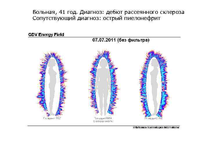 Больная, 41 год. Диагноз: дебют рассеянного склероза Сопутствующий диагноз: острый пиелонефрит 