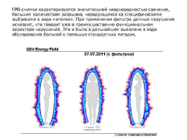 ГРВ-снимки характеризуются значительной неоднородностью свечения, большим количеством разрывов, чередующихся со специфическими выбросами в виде