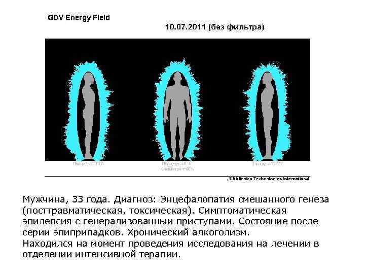 Мужчина, 33 года. Диагноз: Энцефалопатия смешанного генеза (посттравматическая, токсическая). Симптоматическая эпилепсия с генерализованныи приступами.