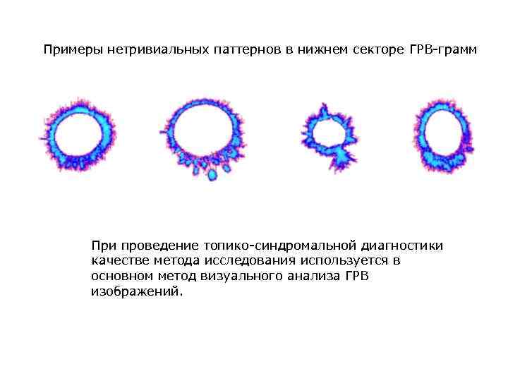 Примеры нетривиальных паттернов в нижнем секторе ГРВ-грамм При проведение топико-синдромальной диагностики качестве метода исследования