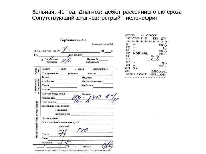 Больная, 41 год. Диагноз: дебют рассеянного склероза Сопутствующий диагноз: острый пиелонефрит 