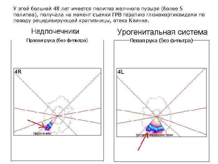У этой больной 48 лет имеется полипоз желчного пузыря (более 5 полипов), получала на