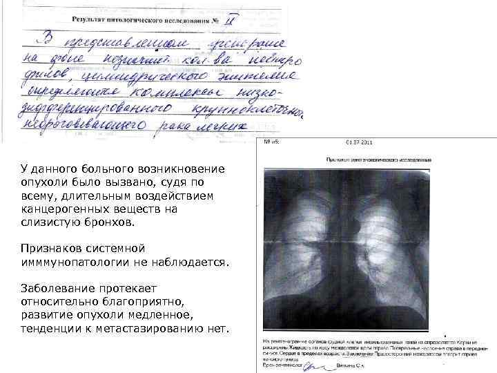 У данного больного возникновение опухоли было вызвано, судя по всему, длительным воздействием канцерогенных веществ