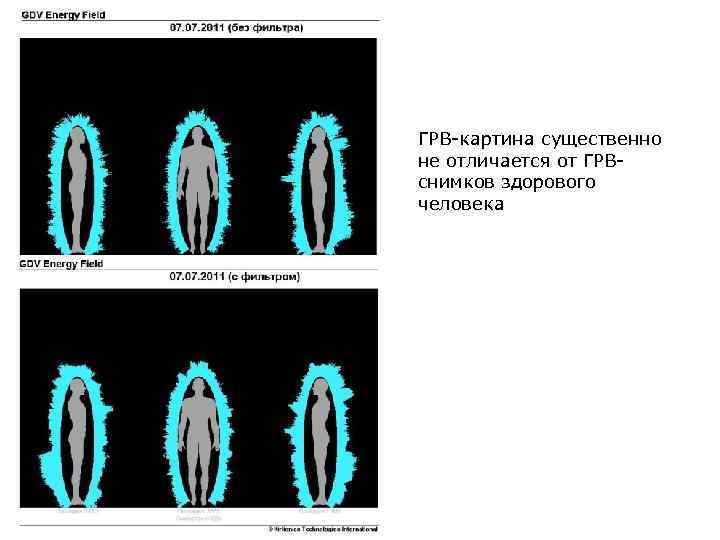 ГРВ-картина существенно не отличается от ГРВснимков здорового человека 