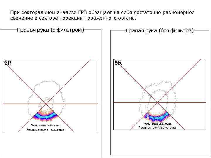 При секторальном анализе ГРВ обращает на себя достаточно равномерное свечение в секторе проекции пораженного
