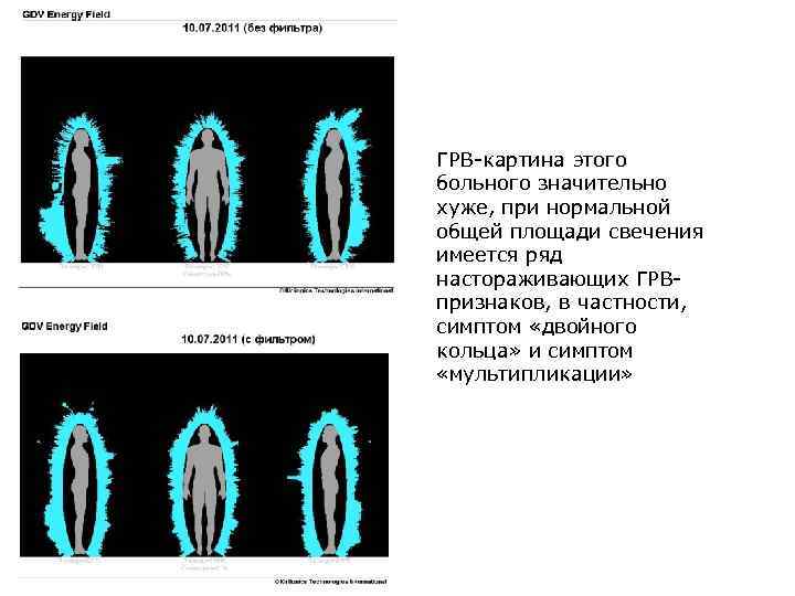 ГРВ-картина этого больного значительно хуже, при нормальной общей площади свечения имеется ряд настораживающих ГРВпризнаков,