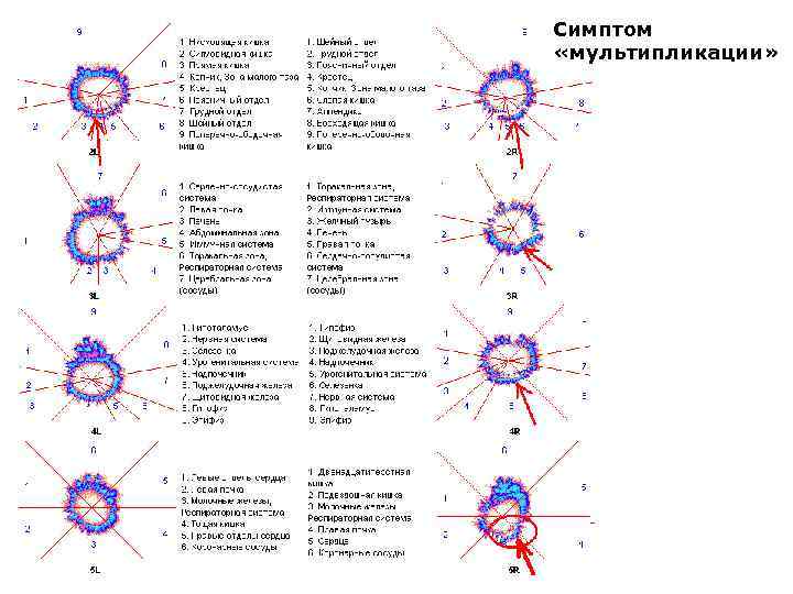 Симптом «мультипликации» 