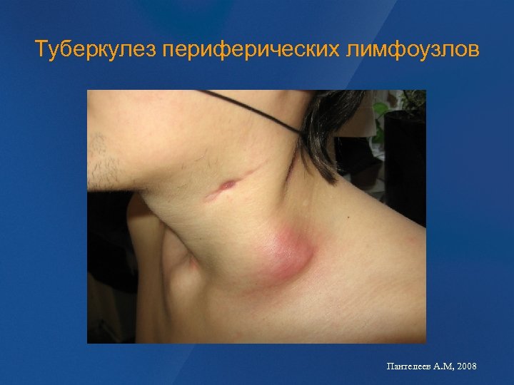 Туберкулез периферических лимфоузлов Пантелеев А. М, 2008 