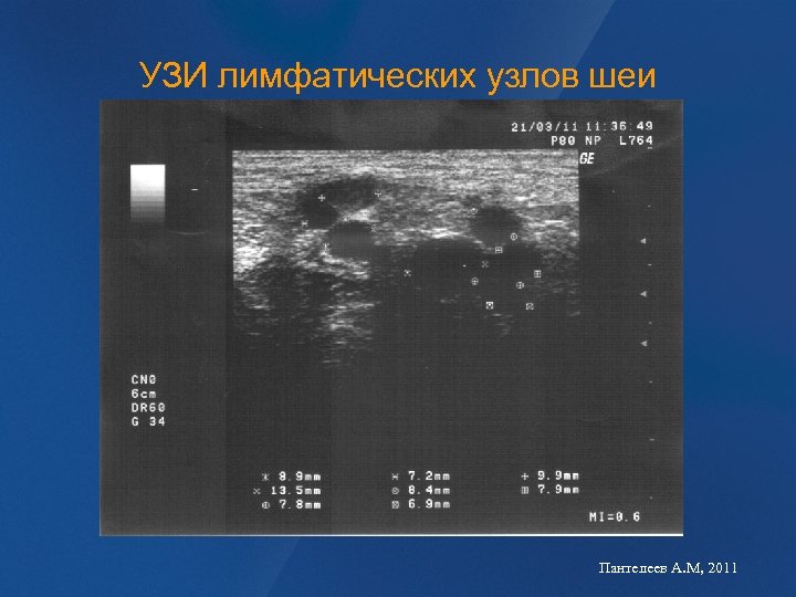 УЗИ лимфатических узлов шеи Пантелеев А. М, 2011 