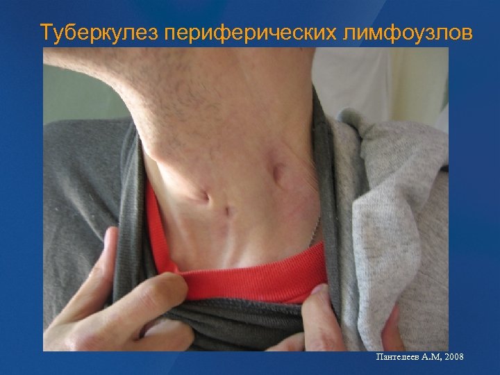 Туберкулез периферических лимфоузлов Пантелеев А. М, 2008 