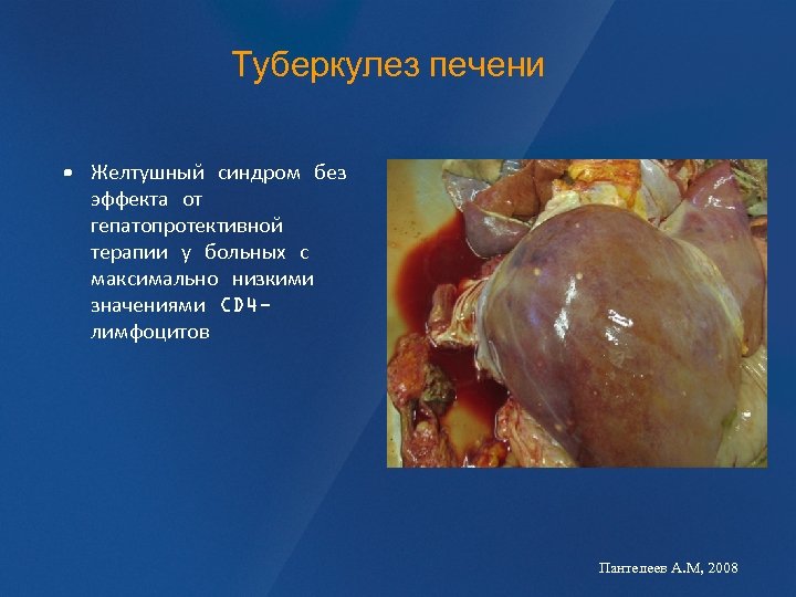 Туберкулез печени • Желтушный синдром без эффекта от гепатопротективной терапии у больных с максимально