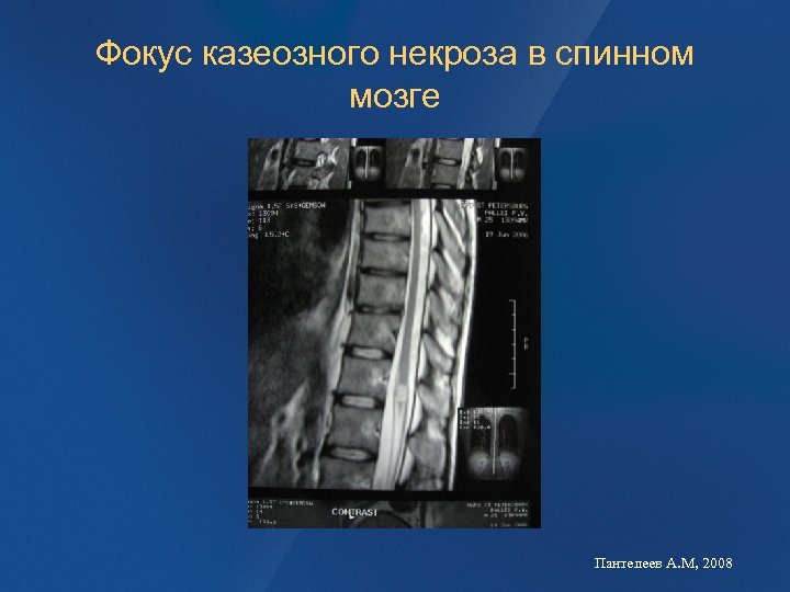 Фокус казеозного некроза в спинном мозге Пантелеев А. М, 2008 