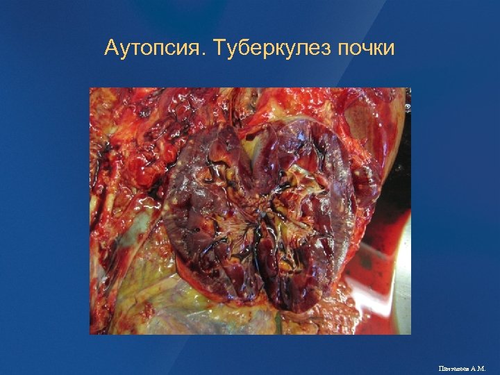 Аутопсия. Туберкулез почки Пантелеев А. М. 