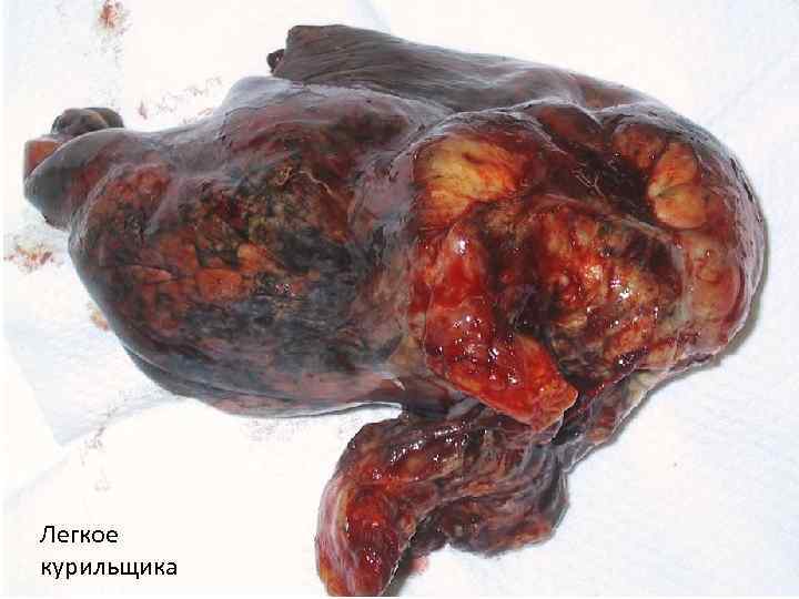 Легкое курильщика 