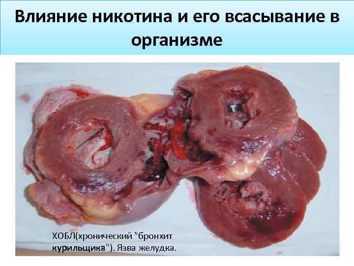 Влияние никотина и его всасывание в организме ХОБЛ(хронический 