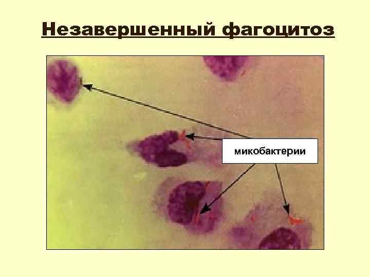 Незавершенный фагоцитоз микобактерии 