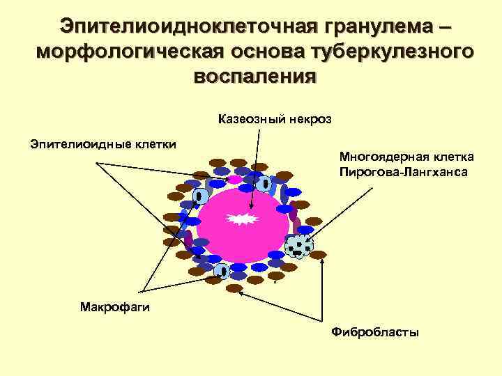 Туберкулезная гранулема рисунок