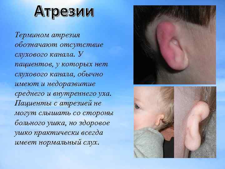 Атрезии Термином атрезия обозначают отсутствие слухового канала. У пациентов, у которых нет слухового канала,