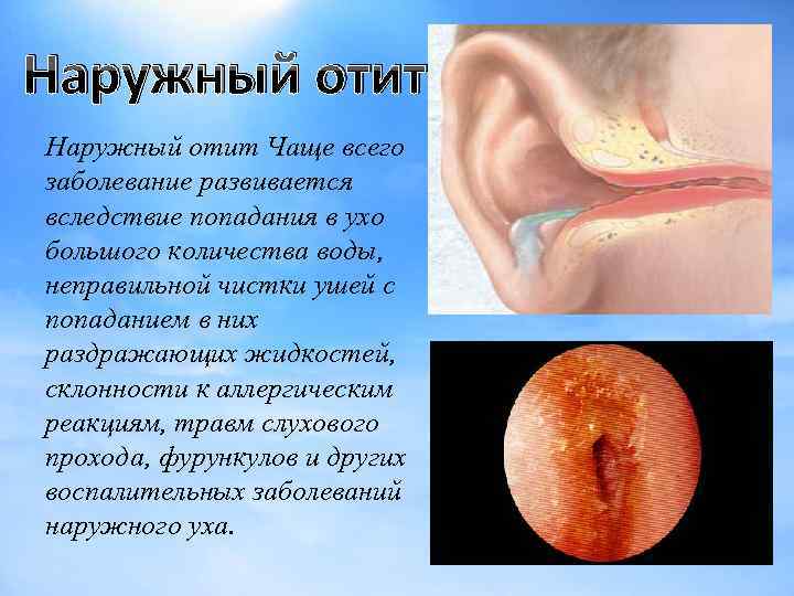 Наружный отит Чаще всего заболевание развивается вследствие попадания в ухо большого количества воды, неправильной