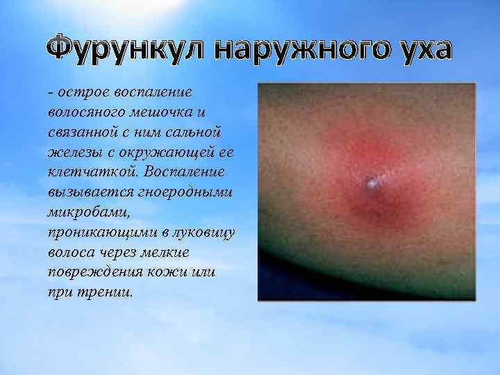 Фурункул наружного уха - острое воспаление волосяного мешочка и связанной с ним сальной железы