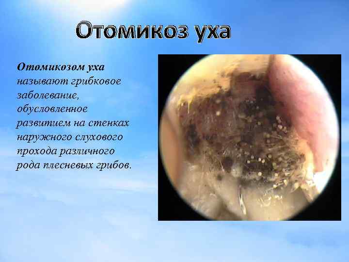 Отомикоз уха Отомикозом уха называют грибковое заболевание, обусловленное развитием на стенках наружного слухового прохода
