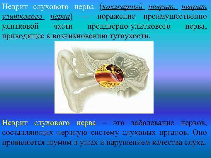 Неврит слухового нерва (кохлеарный неврит, неврит улиткового нерва) — поражение преимущественно улитковой части преддверно-улиткового