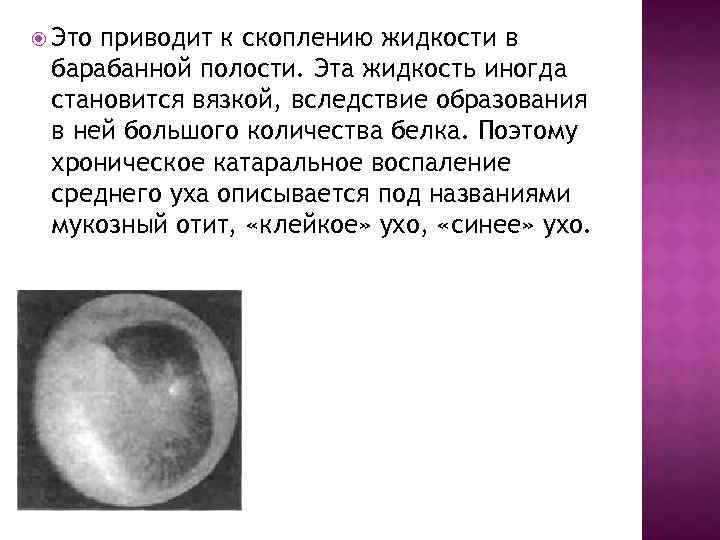  Это приводит к скоплению жидкости в барабанной полости. Эта жидкость иногда становится вязкой,