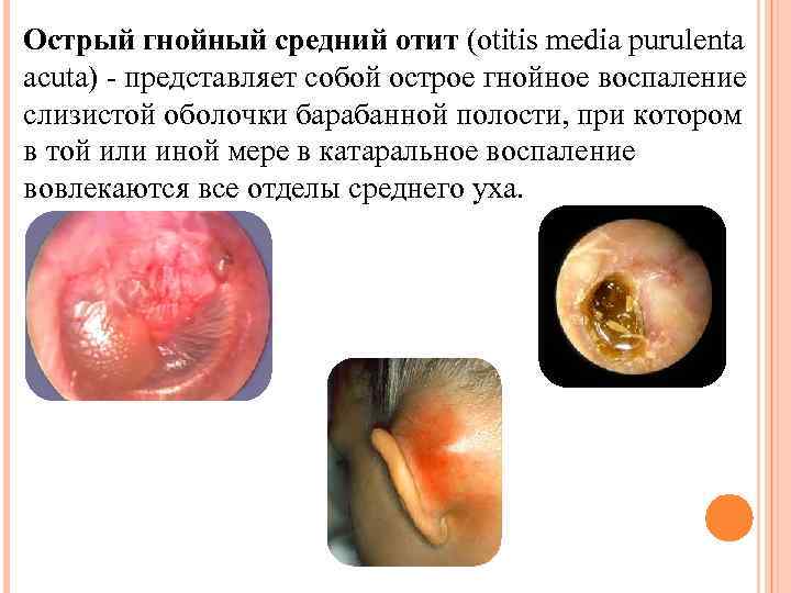 Острый гнойный средний отит (otitis media purulenta acuta) - представляет собой острое гнойное воспаление