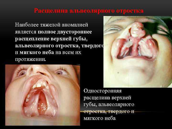 Расщелина альвеолярного отростка Наиболее тяжелой аномалией является полное двустороннее расщепление верхней губы, альвеолярного отростка,