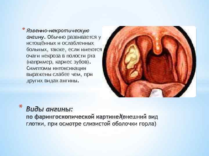 * Язвенно-некротическую ангину. Обычно развивается у истощённых и ослабленных больных, также, если имеются очаги