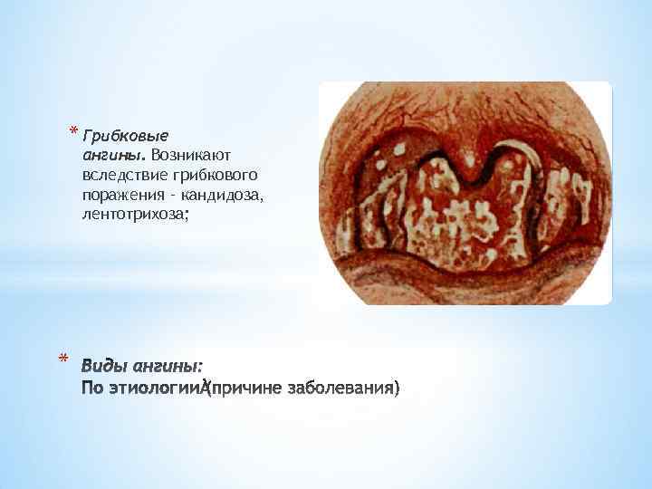 * Грибковые ангины. Возникают вследствие грибкового поражения – кандидоза, лентотрихоза; * 