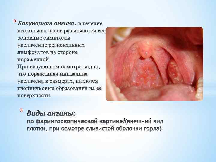 * Лакунарная ангина. в течение нескольких часов развиваются все основные симптомы увеличение региональных лимфоузлов