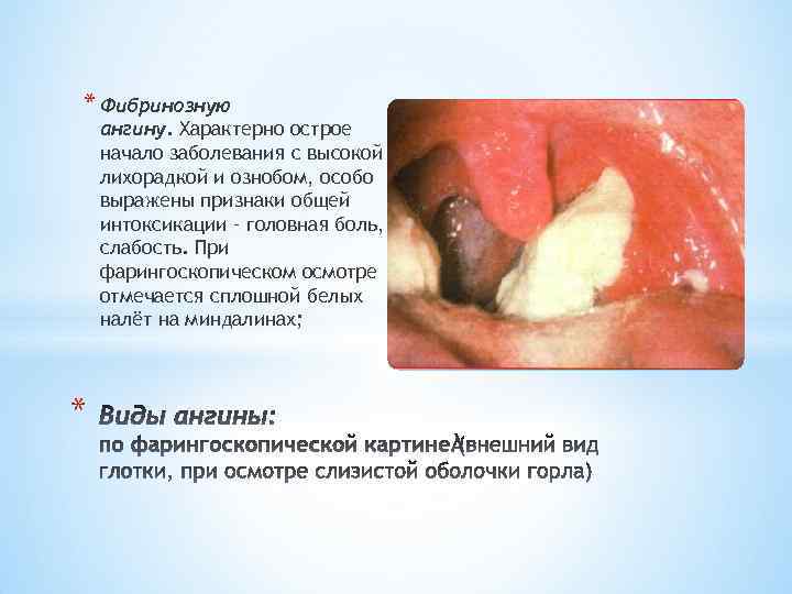 * Фибринозную ангину. Характерно острое начало заболевания с высокой лихорадкой и ознобом, особо выражены