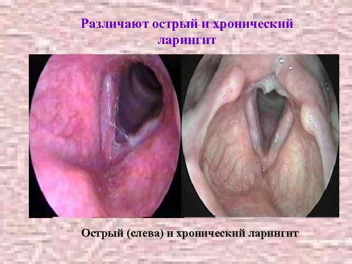 Различают острый и хронический ларингит Острый (слева) и хронический ларингит 