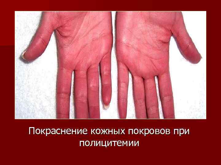 Покраснение кожных покровов при полицитемии 