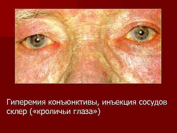 Гиперемия конъюнктивы, инъекция сосудов склер ( «кроличьи глаза» ) 