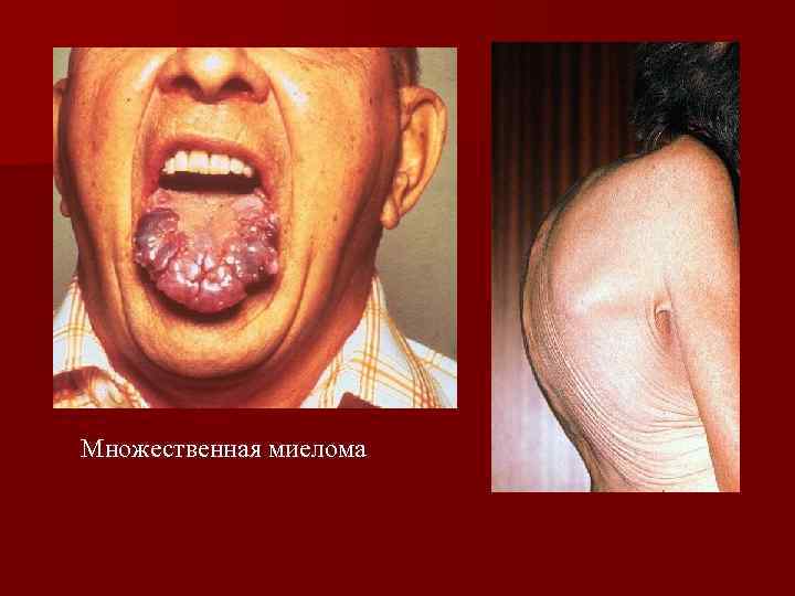 Множественная миелома 