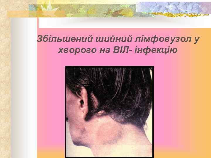 Збільшений шийний лімфовузол у хворого на ВІЛ- інфекцію 