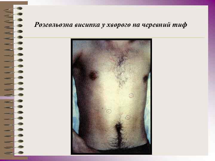 Розеольозна висипка у хворого на черевний тиф 