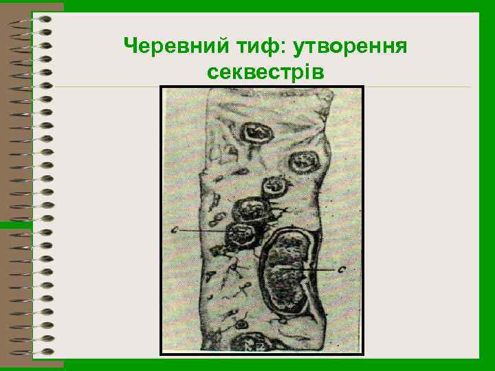 Черевний тиф: утворення секвестрів 