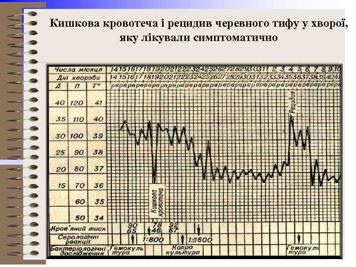 Кишкова кровотеча і рецидив черевного тифу у хворої, яку лікували симптоматично 