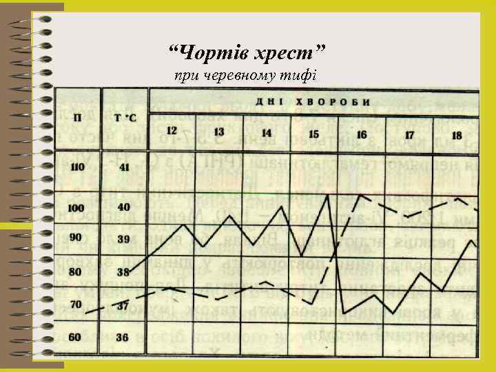 “Чортів хрест” при черевному тифі 