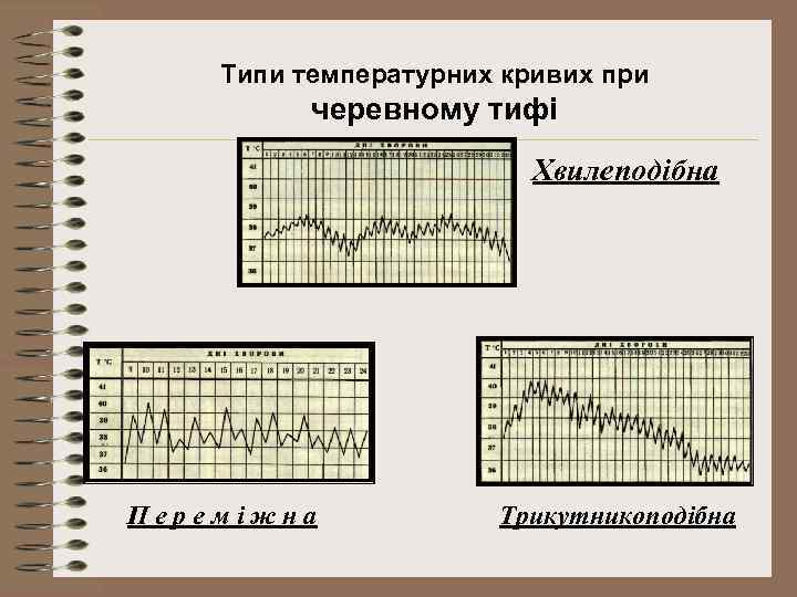 Типи температурних кривих при черевному тифі Хвилеподібна Переміжна Трикутникоподібна 