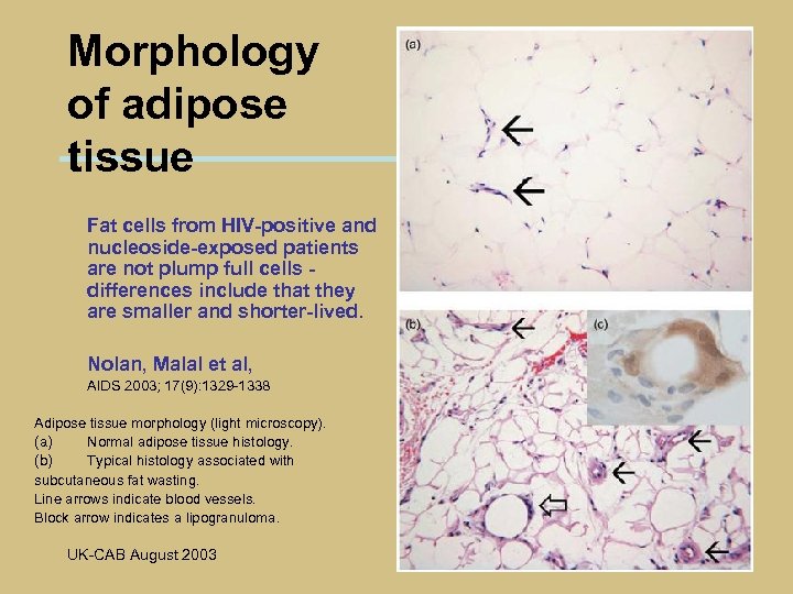 Morphology of adipose tissue Fat cells from HIV-positive and nucleoside-exposed patients are not plump