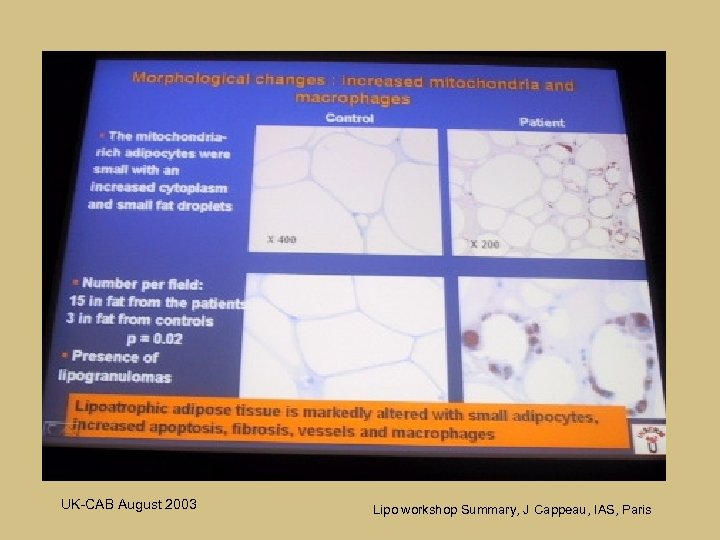 Lipoatrophic tissue UK-CAB August 2003 Lipo workshop Summary, J Cappeau, IAS, Paris 